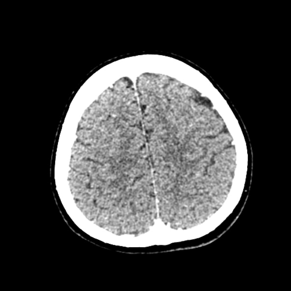File:Cerebral ring enhancing lesions - cerebral metastases (Radiopaedia 44922-48818 B 223).jpg