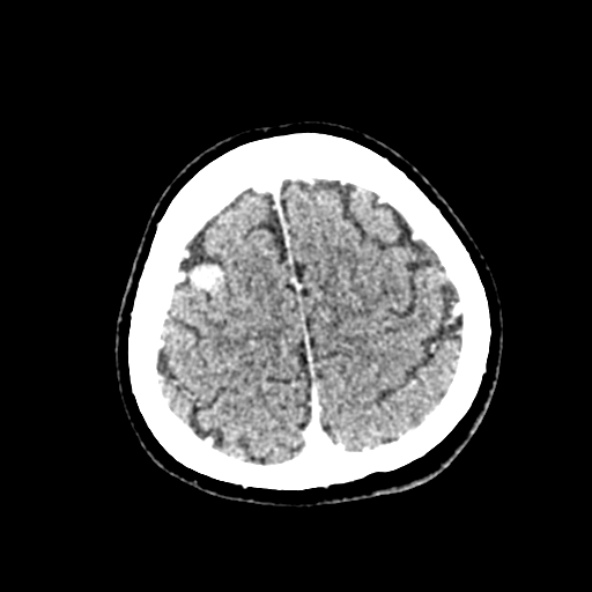 Cerebral ring enhancing lesions - cerebral metastases (Radiopaedia 44922-48818 B 240).jpg