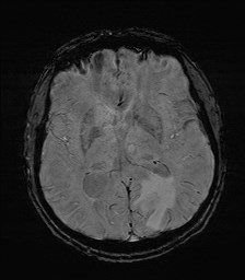 File:Cerebral toxoplasmosis (Radiopaedia 43956-47461 Axial SWI 20).jpg