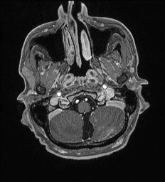 Cerebral toxoplasmosis (Radiopaedia 43956-47461 Axial T1 C+ 5).jpg