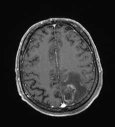 Cerebral toxoplasmosis (Radiopaedia 43956-47461 Axial T1 C+ 56).jpg