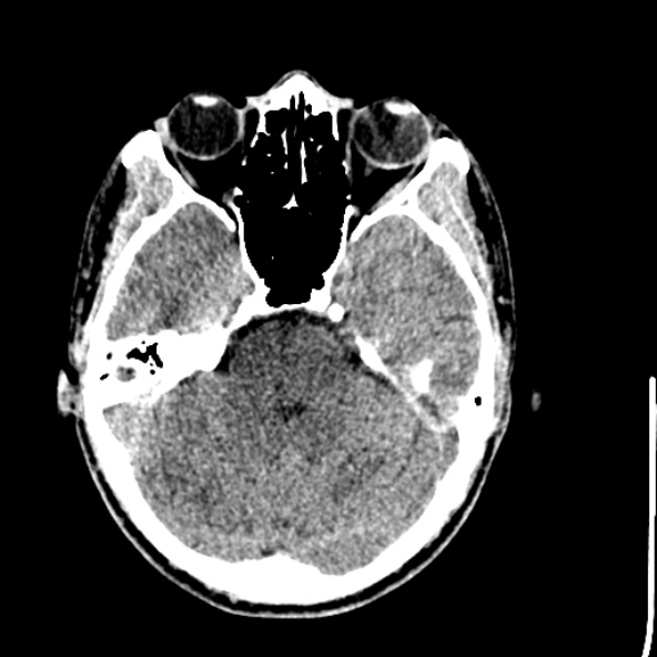 Cerebral toxoplasmosis (Radiopaedia 53993-60131 Axial non-contrast 25).jpg