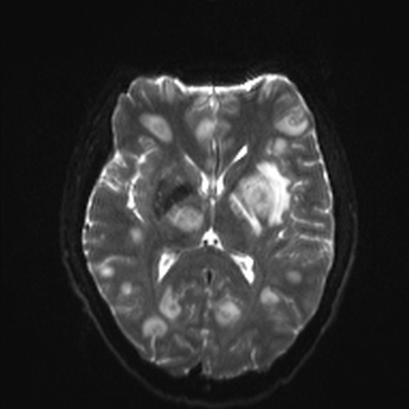 Cerebral toxoplasmosis (Radiopaedia 53993-60132 Axial DWI 14).jpg