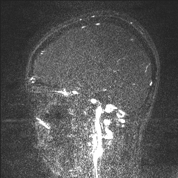 Cerebral tuberculosis with dural sinus invasion (Radiopaedia 60353-68090 Sagittal MRV 102).jpg