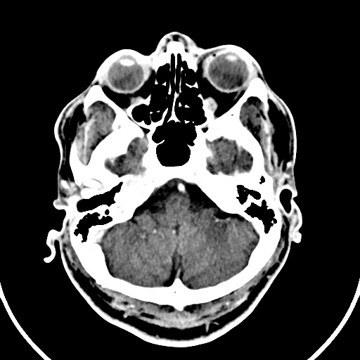 File:Cerebral venous angioma (Radiopaedia 69959-79977 B 4).jpg