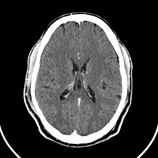File:Cerebral venous angioma (Radiopaedia 69959-79977 B 57).jpg