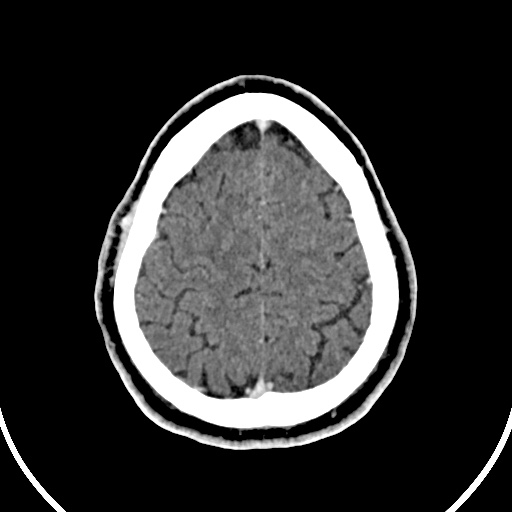 File:Cerebral venous angioma (Radiopaedia 69959-79977 B 88).jpg
