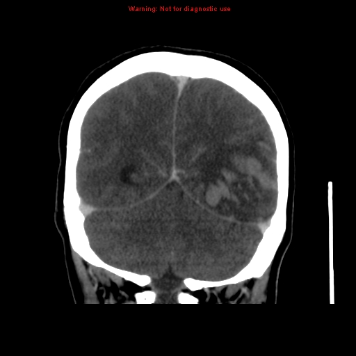 Cerebral venous infarction (Radiopaedia 12404-20735 B 62).jpg