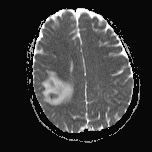 File:Cerebral venous infarction - hemorrhagic (Radiopaedia 81625-95505 Axial ADC 15).jpg
