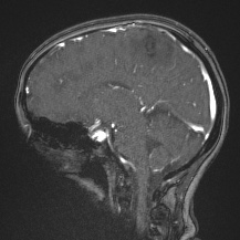 Cerebral venous infarction - hemorrhagic (Radiopaedia 81625-95505 Sagittal MRV 36).jpg