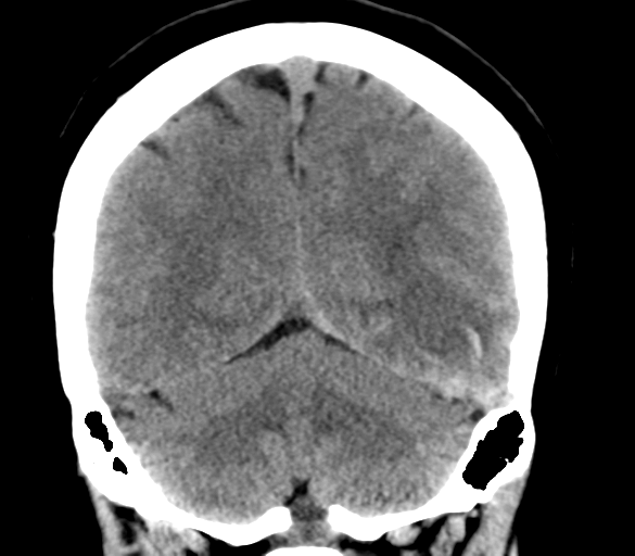 File:Cerebral venous infarction due to transverse sinus thrombosis (Radiopaedia 34688-36116 Coronal non-contrast 27).png