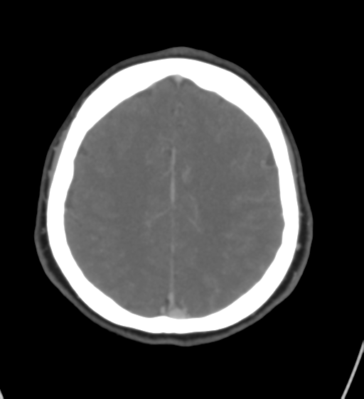Cerebral venous infarction due to transverse sinus thrombosis (Radiopaedia 34688-36120 Axial CT venogram 37).png