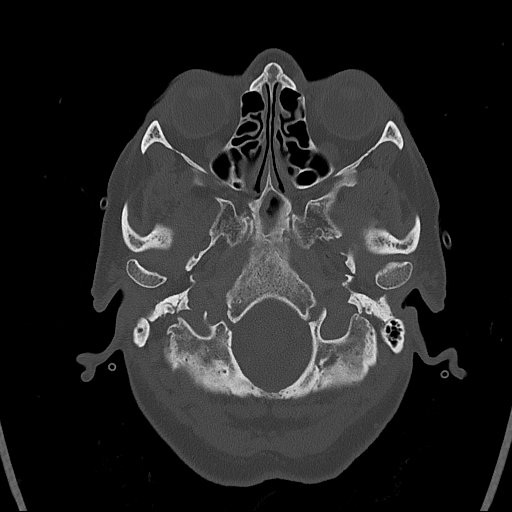 Cerebral venous infarction with hemorrhage (Radiopaedia 65343-74381 Axial bone window 8).jpg