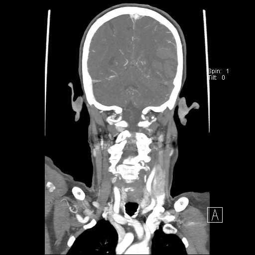 Cerebral venous infarction with hemorrhage (Radiopaedia 65343-74396 B 201).jpg