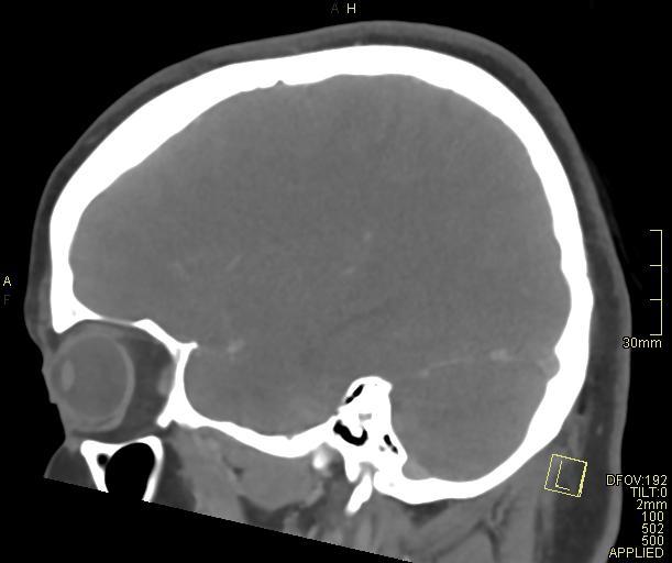 File:Cerebral venous sinus thrombosis (Radiopaedia 91329-108965 Sagittal venogram 22).jpg