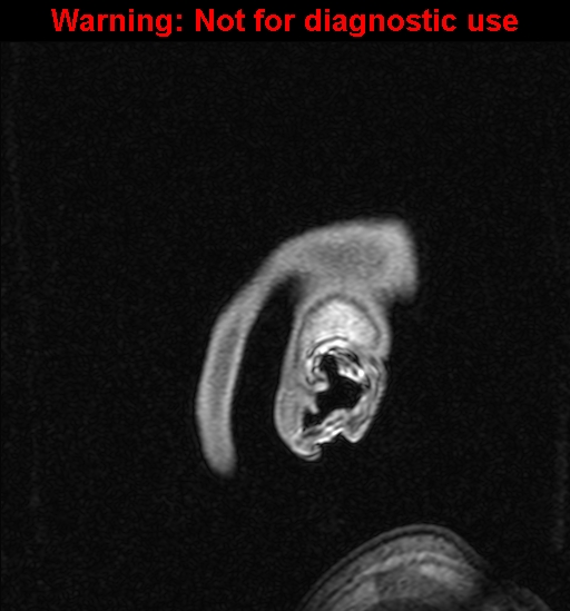 Cerebral venous thrombosis (Radiopaedia 37224-39208 Sagittal T1 C+ 160).jpg