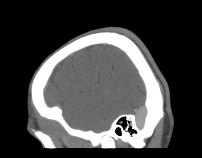 Cerebral venous thrombosis (Radiopaedia 38392-40467 D 45).png