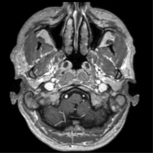Cerebral venous thrombosis (Radiopaedia 38392-40469 Axial T1 C+ 11).png
