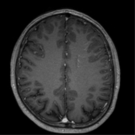 Cerebral venous thrombosis (Radiopaedia 38392-40469 Axial T1 C+ 53).png