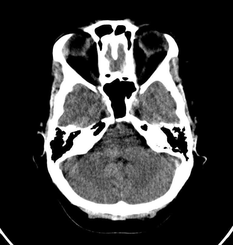 Cerebral venous thrombosis - CT only (Radiopaedia 41031-43778 Axial non-contrast 66).jpg
