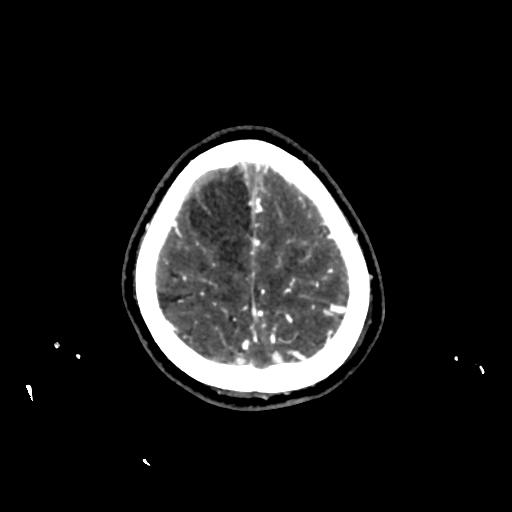 File:Cerebral venous thrombosis - hemorrhagic venous infarction (Radiopaedia 87318-103613 Axial 244).jpg