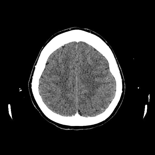 File:Cerebral venous thrombosis with venous hemorrhagic infarct (Radiopaedia 90354-107660 Axial with contrast 125).jpg