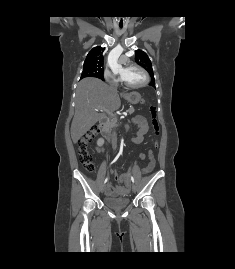 Cervical aortic arch with coarctation and aneurysms (Radiopaedia 44035-47552 C 28).jpg