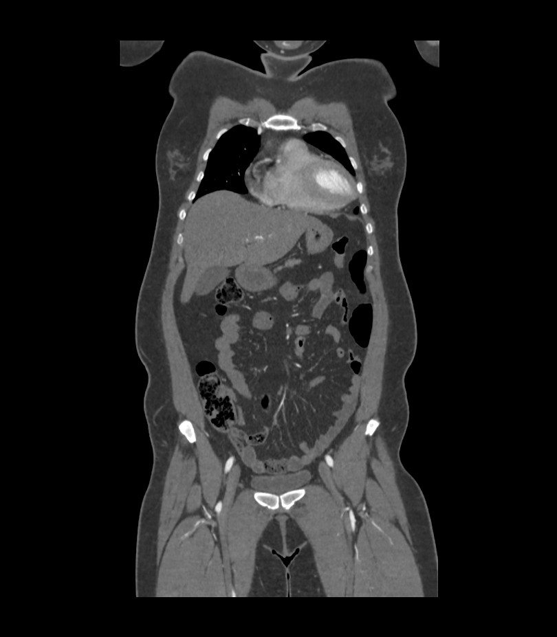 Cervical aortic arch with coarctation and aneurysms (Radiopaedia 44035-47552 C 35).jpg