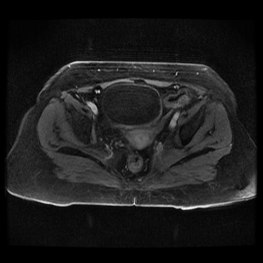 Cervical carcinoma (Radiopaedia 70924-81132 Axial T1 C+ fat sat 229).jpg