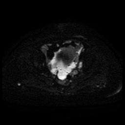 Cervical carcinoma (Radiopaedia 85405-101028 Axial DWI 32).jpg