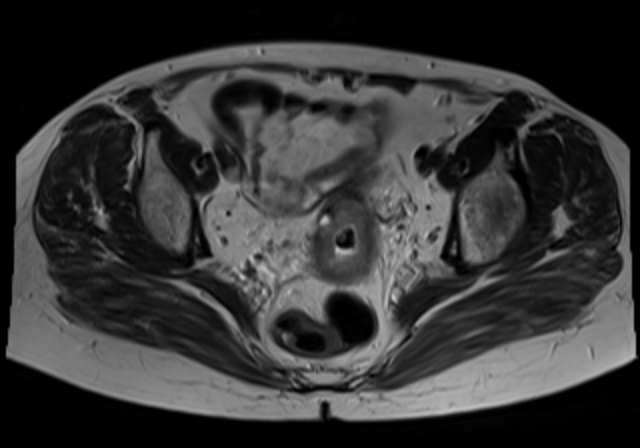 File:Cervical carcinoma (Radiopaedia 88312-104943 Sagittal T1 12).jpg