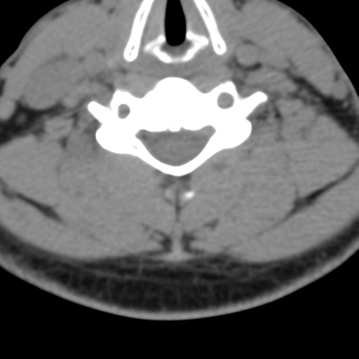 Cervical schwannoma (Radiopaedia 57979-64974 Axial non-contrast 43).png