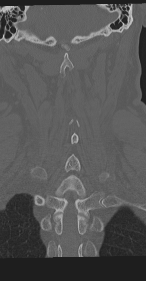 Cervical spine fracture in the setting of ankylosis (Radiopaedia 37038-38715 Coronal bone window 52).png