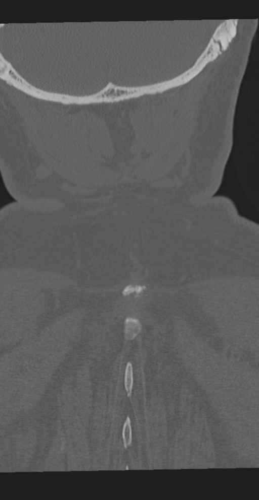 Cervical spine fracture in the setting of ankylosis (Radiopaedia 37038-38715 Coronal bone window 68).png