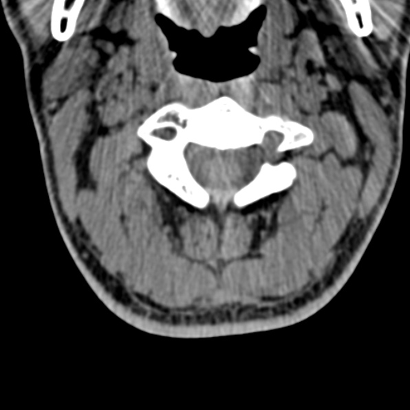 Cervical spondylodiscitis (Radiopaedia 28057-29489 Axial non-contrast 27).jpg