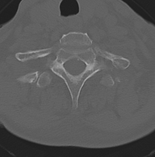 File:Cervical spondylolysis (Radiopaedia 49616-54811 Axial bone window 45).png