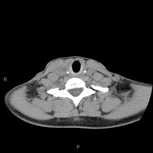 Cervical thymic cyst (Radiopaedia 88632-105335 Axial non-contrast 42).jpg