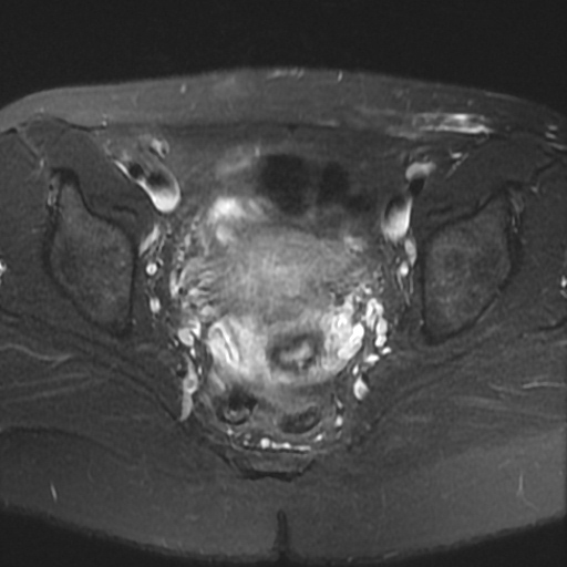 File:Cesarian section scar endometriosis (Radiopaedia 66520-75799 Axial T2 fat sat 14).jpg