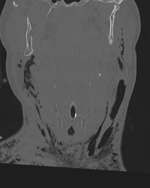 Chalk stick fracture (Radiopaedia 57948-64928 Coronal bone window 14).png
