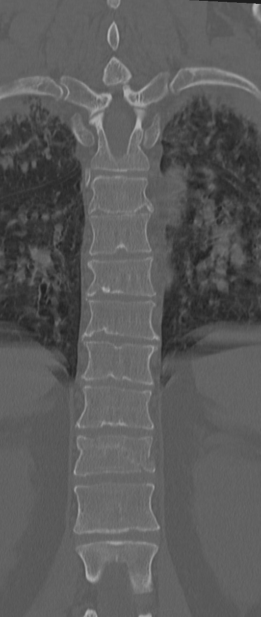 Chance fracture (Radiopaedia 33854-35020 Coronal bone window 50).png