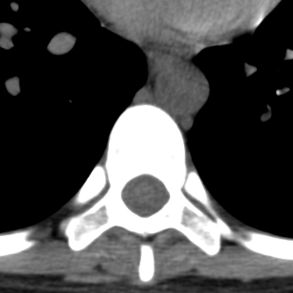 File:Chance fracture (Radiopaedia 36521-38081 Axial non-contrast 17).jpg