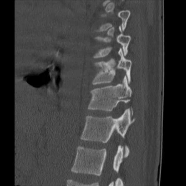Chance fracture (Radiopaedia 36521-38081 Sagittal bone window 48).jpg
