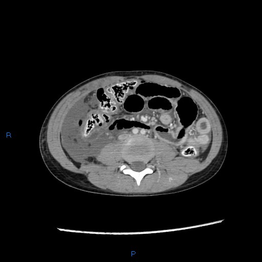 File:Chance fracture with duodenal and pancreatic lacerations (Radiopaedia 43477-46864 A 25).jpg