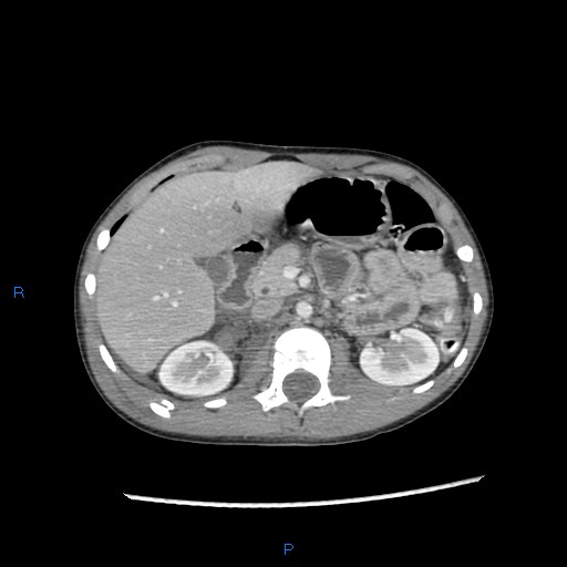 File:Chance fracture with duodenal and pancreatic lacerations (Radiopaedia 43477-46864 A 8).jpg