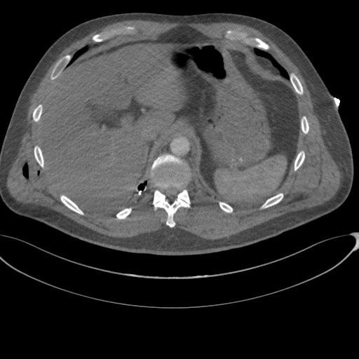 File:Chest multitrauma - aortic injury (Radiopaedia 34708-36147 A 276).png