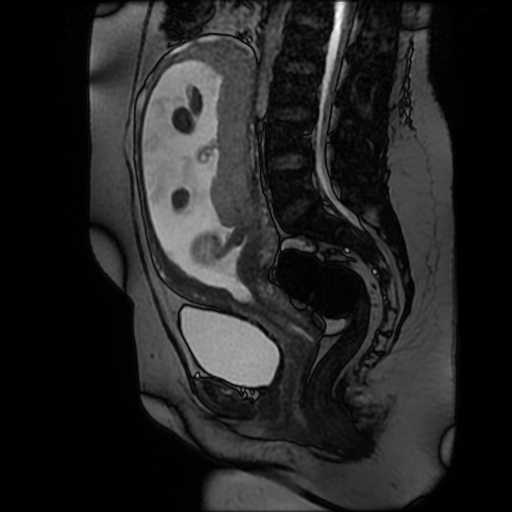 Chiari II malformation - fetal MRI (Radiopaedia 68099-77581 Sagittal Fiesta 30).jpg