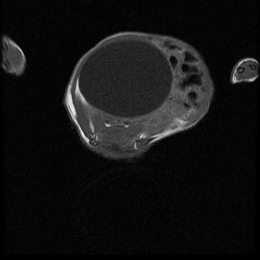 File:Chiari II malformation with spinal meningomyelocele (Radiopaedia 23550-23652 Axial T1 14).jpg