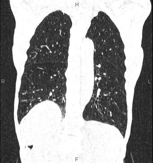 Chilaiditi sign (Radiopaedia 88839-105611 Coronal lung window 45).jpg