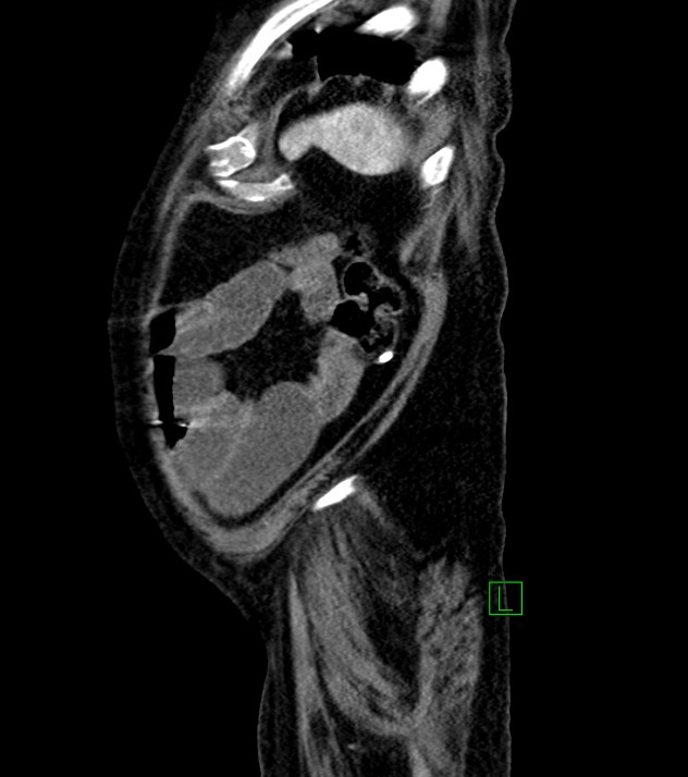 Cholangiocarcinoma with cerebral metastases (Radiopaedia 83519-98629 F 17).jpg