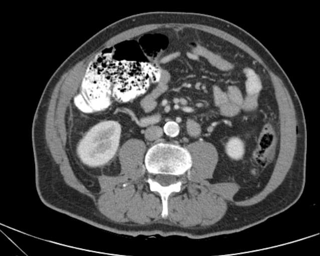 File:Cholecystitis - perforated gallbladder (Radiopaedia 57038-63916 A 46).jpg